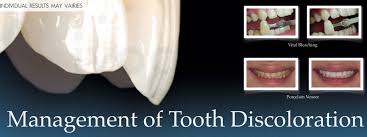 Image result for Tooth Discoloration