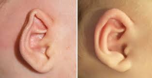 Infant Ear Molding