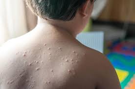 Demam, sakit kepala, sakit punggung, dan merasa lelah. Sudah Tahu Fakta Mengenai Cacar Air Ini