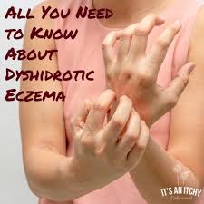 What Is Dyshidrotic Eczema Home Remedies For Eczema Eczema Treatment Eczema