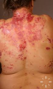 Image result for Pemphigoid