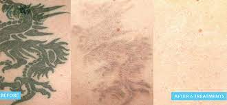 Laser tattoo removal has multiple variables that affect safety and cost, our free consult enables us to come up with the best possible treatment plan for you. Laser Tattoo Removal High Point Nc Infinite Allure