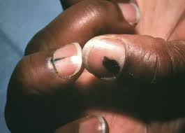 Image result for Acral lentiginous melanoma nail
