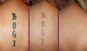 After a treatment, you'll see redness, formally called purpura, in the area treated by laser removal. Laser Tattoo Removal Enlighten Tan Med Spa