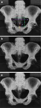 We did not find results for: Simple Mechanical Devices Did Not Improve Pelvis Positioning In Ap Pelvis Radiographs For Reliable Assessment Of The Acetabular Orientation Journal Of Experimental Orthopaedics Full Text