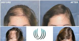 Radiation therapy also can cause hair loss radiation therapy also attacks quickly growing cells in your body, but unlike chemotherapy, it affects only the specific area where treatment is concentrated. Patient Qlr Is A Woman In Her 20 S Who Had Lost Hair On The Front And Top Of Her Scalp Following Radiotherapy Aft Hair Loss Women Lost Hair Hair Restoration