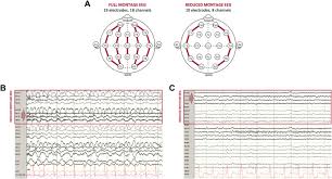 Midline And Parasagittal Seizures Are Rare In Adult Patients Springerlink
