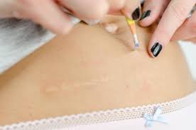 Ingrown hairs are may be produced by shaving too closely. Ingrown Hair Treatment And Prevention