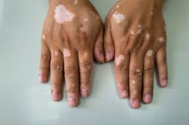 Image result for Vitiligo
