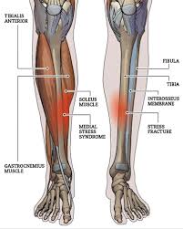 Image result for Shin Splints