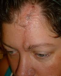 Find facts and statistics for reporting about skin cancer. Mum Too Young For Skin Cancer Had To Have Five Surgeries To Reconstruct Face Mirror Online