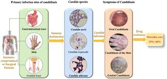 Image result for Candidiasis