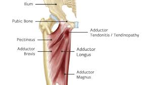Ice the inside of your thigh to reduce pain and swelling. Adductor Tendinopathy An Athlete S Struggle With Groin Pain Diversified Integrated Sports Clinicdiversified Integrated Sports Clinic