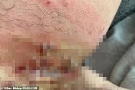 Take ibuprofen for the swelling. Hair Removal Cream Burn Treatment