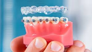 Snag Tooth: Snaggle Tooth Causes, Symptoms & Prevention