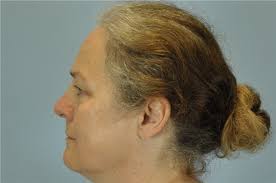 Eyelid Surgery Before and After Photos by Paul Vanek, MD, FACS; Concord, OH 