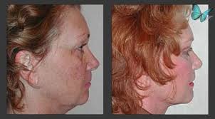 Facelift Beverly Hills