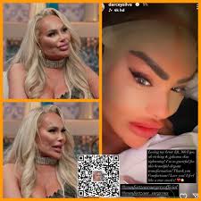 I'm not a doctor, but I believe Darcey's massive chin implant stretched her  face downward, making her eyebrows appear lower. This might be why she  recently went back to Turkey for an