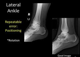 Good Lateral Ankle Diagnostic Imaging Radiology Imaging Radiology Schools