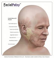 The swollen nerve presses against the bone around it. What Is Facial Palsy Facial Palsy Uk