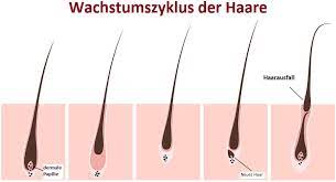 Nach der haartransplantation fallen die spenderhaare zunächst wieder aus, da die haarfollikel von der transplantation geschwächt sind. Fallen Transplantierte Haarfollikel Nach Haartransplantation Wieder Aus