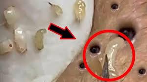 Our blackheads removal videos includes Skincare Blackheads Removal Pimple Princess