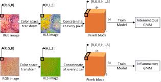 How do doctors determine the stage of colon cancer? Computer Aided Diagnosis Of Colorectal Polyps Using Linked Color Imaging Colonoscopy To Predict Histology Scientific Reports