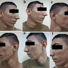A 21-year man, right side: combined treatment side, a; before...