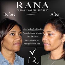 Dr. Nik Rana (@ranafacialplasticsurgery) • Instagram photos and videos