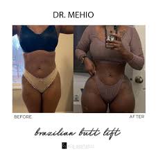 I inquired about a procedure with dr mehio. Mia Aesthetics Who Else Loves A Transformation Facebook