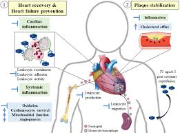 Image result for Myocardial Infarction Stabilization