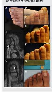 Image result for Glomus tumor