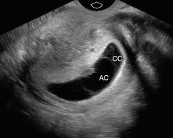 Image result for First Trimester Ultrasound