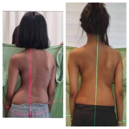 Have you heard of Schroth Therapy for Scoliosis? Schroth therapy is a scoliosis-specific exercise program that can help in: • improving your posture • pain reduction • stabilizing the spine, to prevent