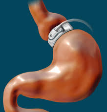 Adipositaschirurgie Wikipedia