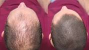 First Signs Of Hair Thinning