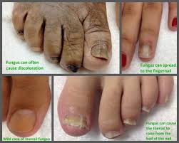 The medical experts at foot vitals explain the causes, symptoms & treatment of toe fungus. Different Types Of Toenail Fungus Awesome Nail