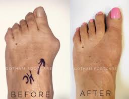 A bunion is a deformity of the great toe characterized by a lateral deviation of it. Considering Bunion Surgery Gotham Footcare Podiatrists