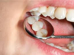Dental sealants are thin, plastic films bonded to the chewing surfaces of the back teeth—molars and premolars. Safe Dental Sealants For Children At Somerset Smiles