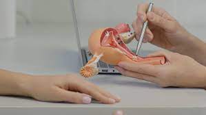 Tubal ligation is a form of female sterilization in which a doctor or surgeon blocks or removes the fallopian tubes to prevent pregnancy permanently. Pros And Cons Of Getting Your Tubes Tied Cool Springs Obgyn