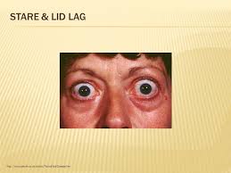 As the object is moved downward and the. Hyperthyroidism And Graves Disease Ppt Download