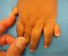 Image result for Polydactyly