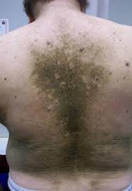 To get rid of the dry skin on your neck, you must hydrate properly, both internal and external. Terra Firma Forme Dermatosis Revisited