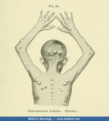 Image result for Chorea