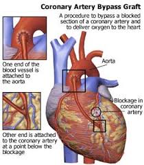 Pin By Sonja On Emt Futureparmedic Cardiac Nursing Coronary Arteries Heart Surgery