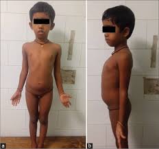 Image result for Precocious Puberty