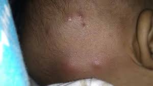 Klikdokter.com bisul adalah infeksi bakteri yang memicu peradangan di dalam folikel rambut (lubang tempat rambut tumbuh), berikut gejala, pengobatan dan pencegahannya Penyebab Dan Cara Mengobati Bisul Pada Bayi Yang Aman Lampung Co