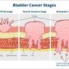 Less common symptoms of bladder cancer include: 3