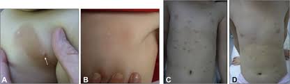 Criteria For The Regression Of Pediatric Mastocytosis A Long Term Follow Up The Journal Of Allergy And Clinical Immunology In Practice 27 octobre 202027 octobre 2020 julien rossignolsport. regression of pediatric mastocytosis