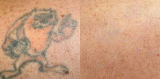 Los angeles , ca 90057. Open Canvas Tattoo Removal Uses Lasers To Fade Away Ink And More Strokes Plugs San Luis Obispo New Times San Luis Obispo
